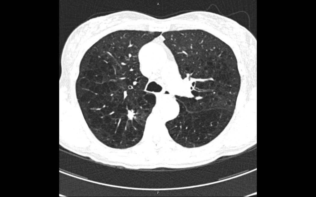 Corte axial de tomografia de tórax com um nódulo pulmonar
